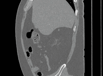 /code/10khrs-ai-ml-dl/projects/kits19/sagittal.gif /code/10khrs-ai-ml-dl/projects/kits19/sagittal.gif